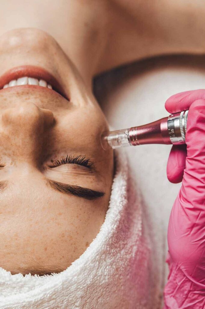 Glad kvinde får en microneedling behandling på ansigtet, hvor en specialist anvender en enhed til at forbedre hudens udseende